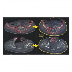 SAM Sling Otomatik Pelvik Sabitleme Kemeri